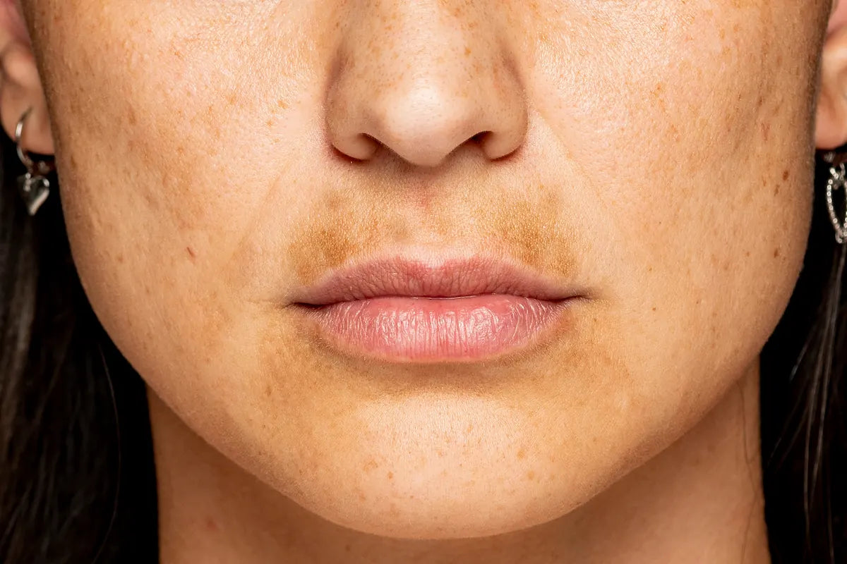 4-Butylresorcinol for Hyperpigmentation: Complete Cosmetic Formulation Guide
