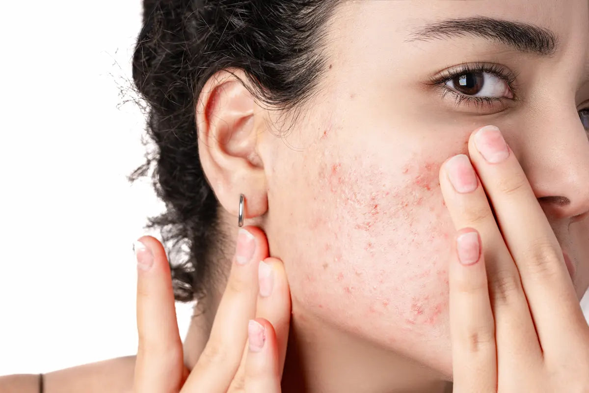Zinc PCA in Skincare for Oily Skin, Acne, Sebum Control and Scalp Care: Complete Formulation Guide