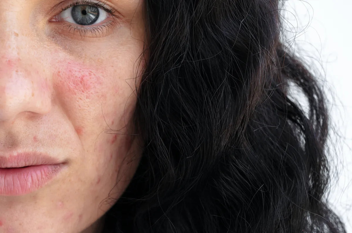 Uses of Allantoin in Skincare