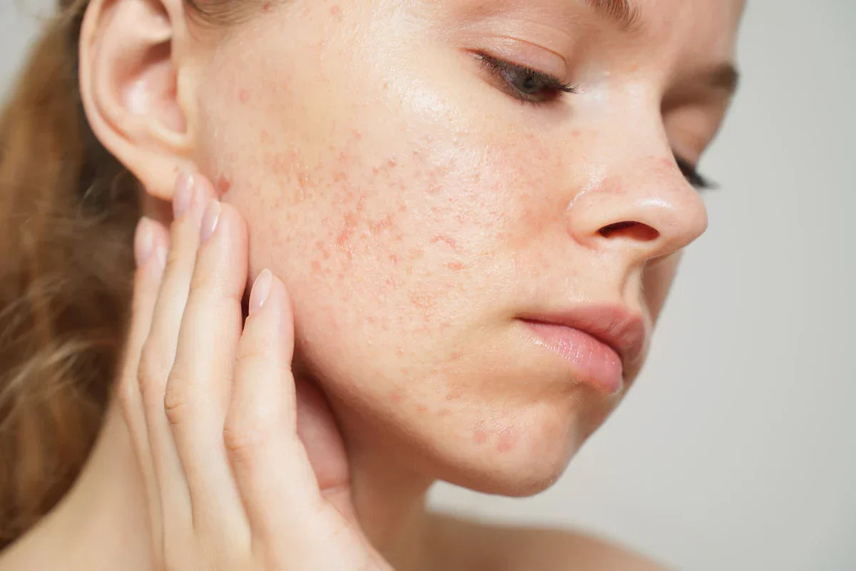 Traditional Salicylic Acid vs Encapsulated Salicylic Acid: A Formulator’s Guide