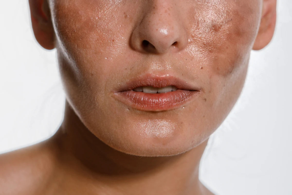 The Secret to Even Skin- How Alpha Arbutin Targets Hyperpigmentation