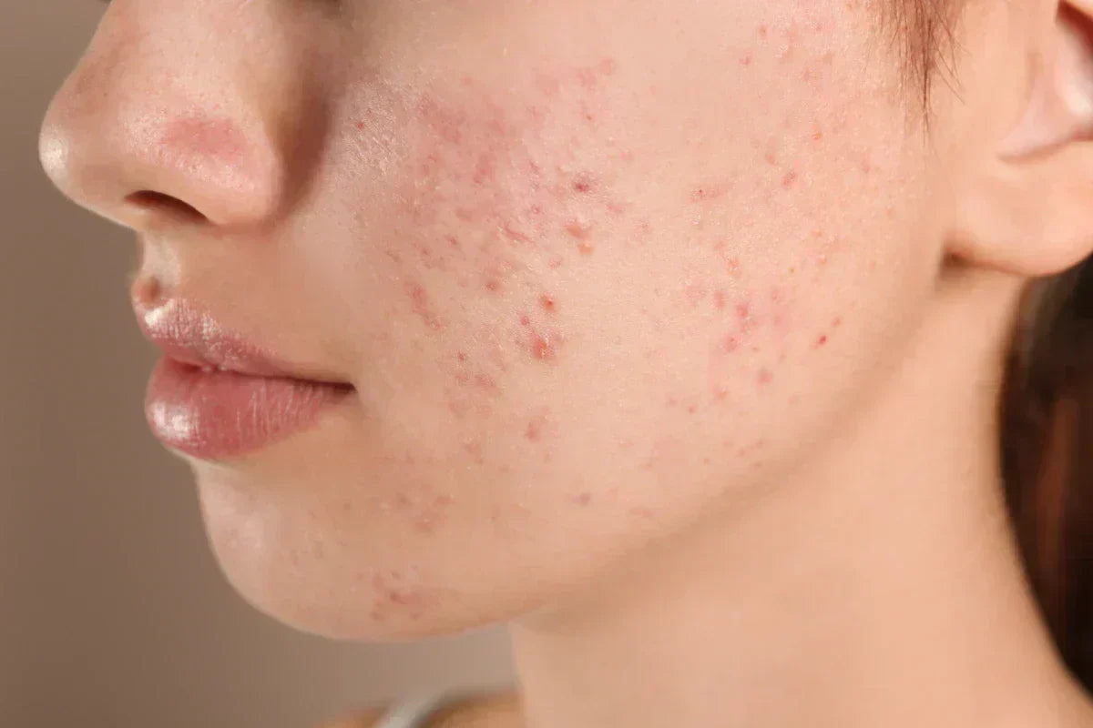Traditional Salicylic Acid vs Encapsulated Salicylic Acid: A Formulator’s Guide