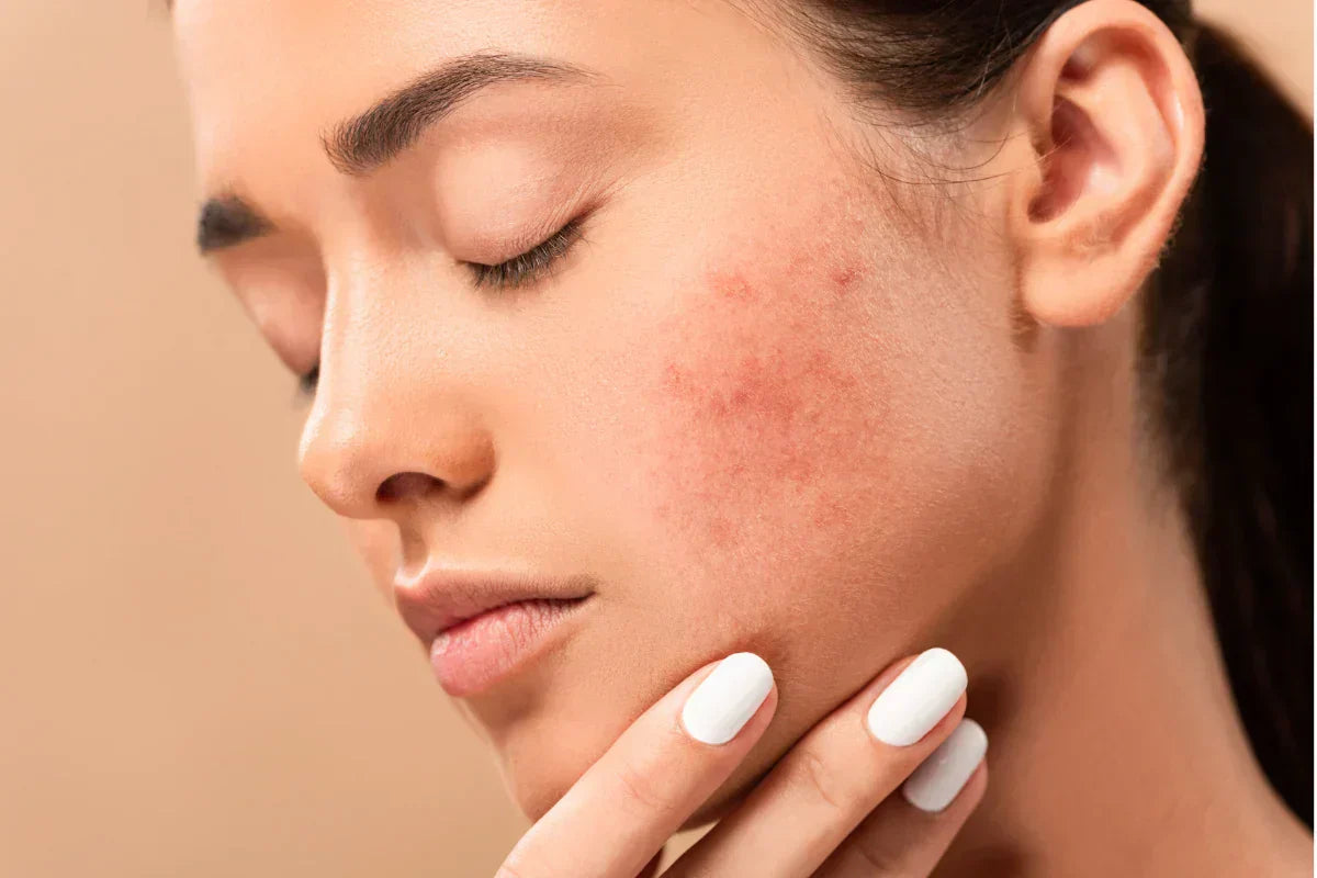 Facial skin showing mild redness and irritation, highlighting the need for barrier-supporting skincare.