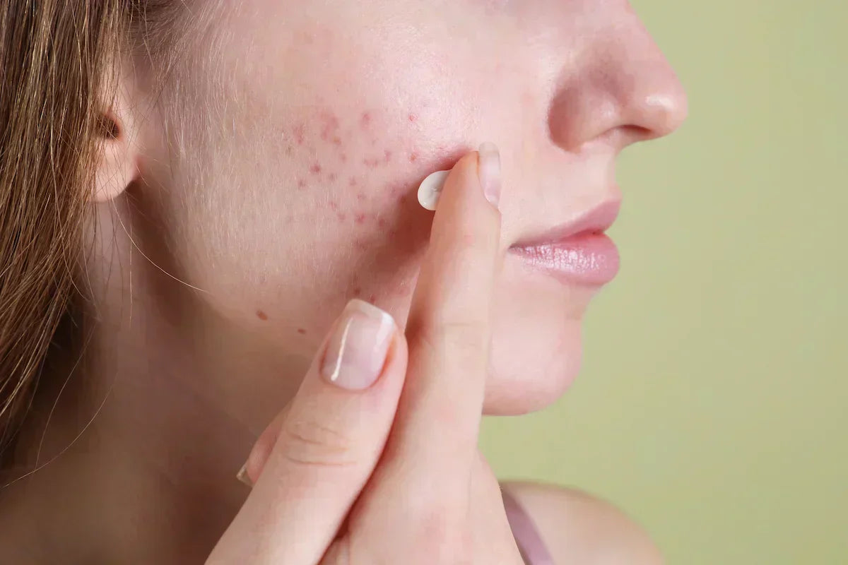 Tranexamic Acid in Skincare for Hyperpigmentation, Melasma and Skin Brightening: Complete Formulation Guide